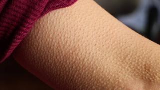 A closeup of someone's arm that's covered in goosebumps.